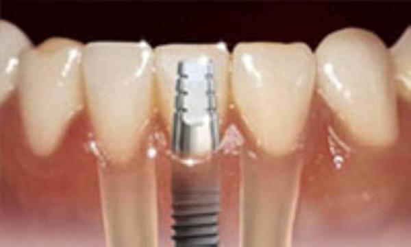 بارگذاری فوری در ایمپلنت های دندانی