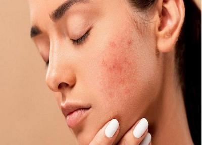 6 روش درمان جوش گرمازدگی با مواد طبیعی در خانه